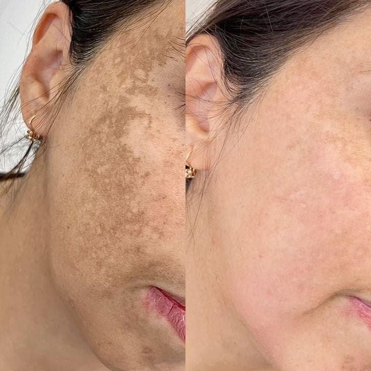 Melasma Treatment treatment at House of Aesthetics, DHA Phase 6 Lahore
