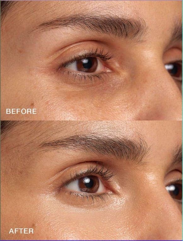Under-Eye Treatment before and after result 1 — House of Aesthetics DHA Phase 6 Lahore
