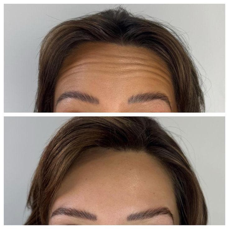 Botox & Fillers before and after result 2 — House of Aesthetics DHA Phase 6 Lahore