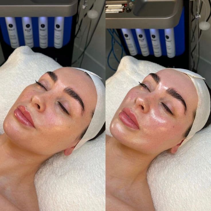 HydraFacial before and after result — House of Aesthetics DHA Phase 6 Lahore