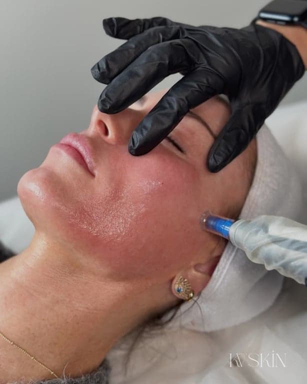 Mesotherapy before and after result 2 — House of Aesthetics DHA Phase 6 Lahore