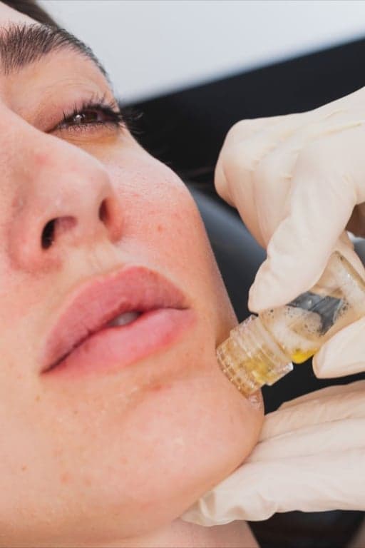 Mesotherapy before and after result 1 — House of Aesthetics DHA Phase 6 Lahore