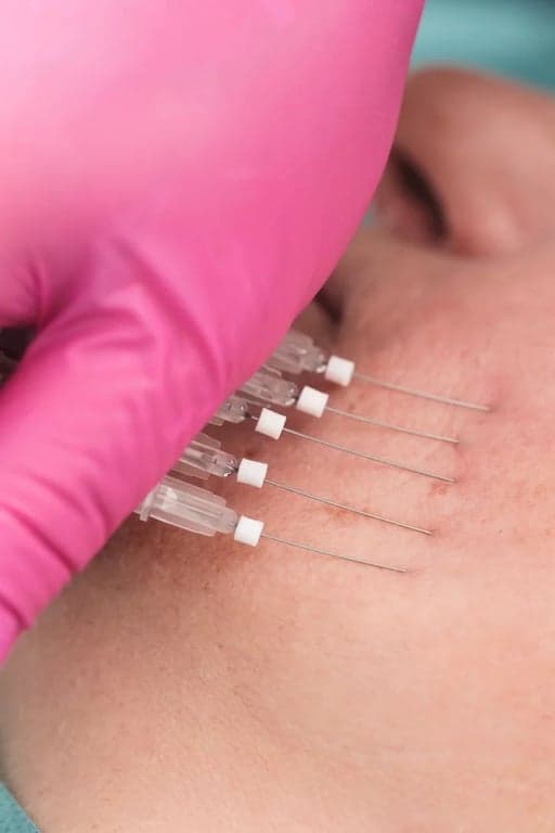 Polynucleotide Therapy before and after result 1 — House of Aesthetics DHA Phase 6 Lahore