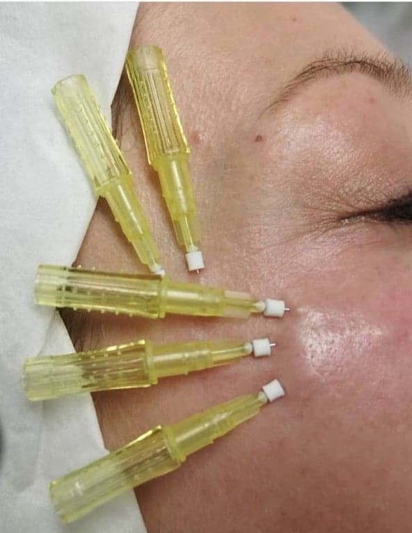 Polynucleotide Therapy before and after result 2 — House of Aesthetics DHA Phase 6 Lahore