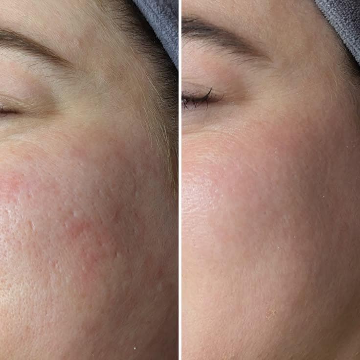 Pore Minimisation treatment at House of Aesthetics, DHA Phase 6 Lahore
