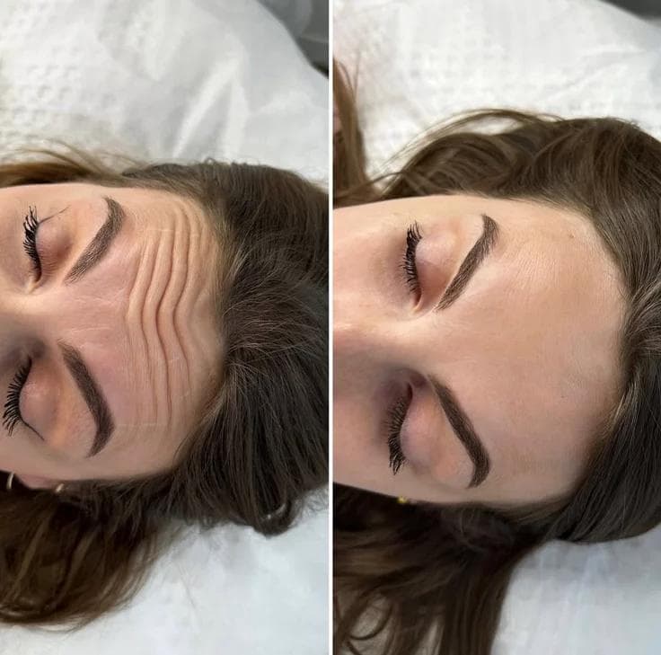Botox & Fillers before and after result 1 — House of Aesthetics DHA Phase 6 Lahore