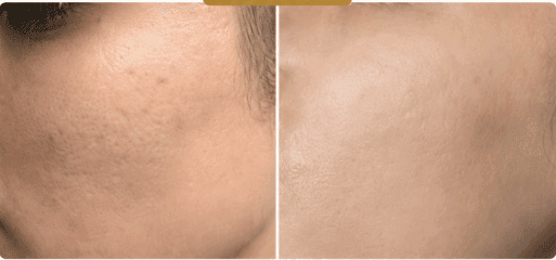 Acne & Pigmentation Treatment before and after result 2 — House of Aesthetics DHA Phase 6 Lahore