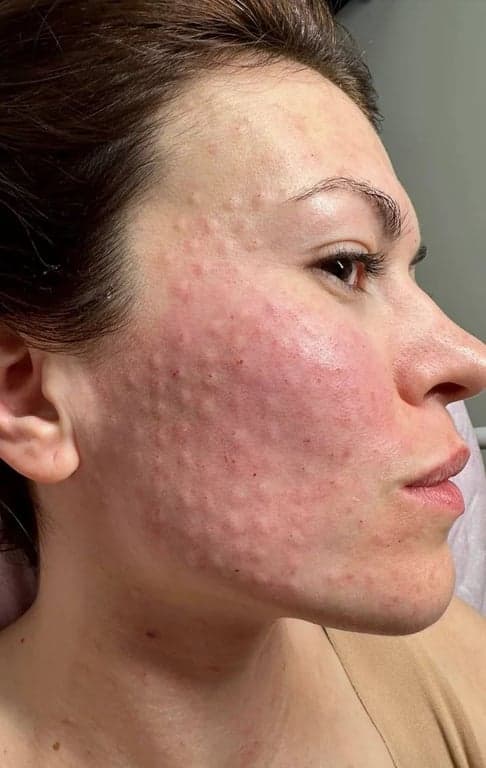 Acne & Pigmentation Treatment treatment at House of Aesthetics, DHA Phase 6 Lahore