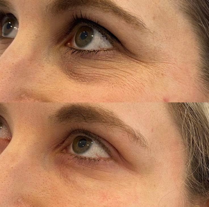 Under-Eye Treatment before and after result 2 — House of Aesthetics DHA Phase 6 Lahore