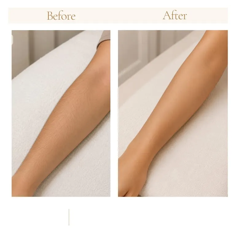 Laser Hair Removal · Full Body before and after results — House of Aesthetics DHA Phase 6 Lahore