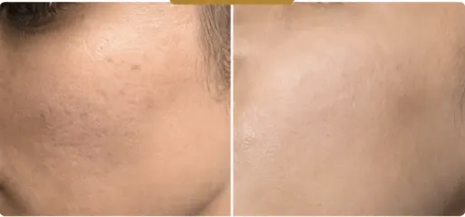 Acne and Acne Scar Treatment before and after result 2 — House of Aesthetics DHA Phase 6 Lahore