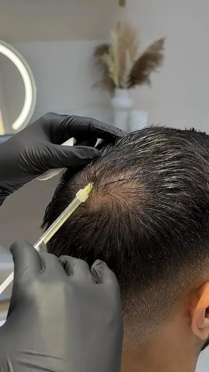 PRP Therapy treatment at House of Aesthetics, DHA Phase 6 Lahore