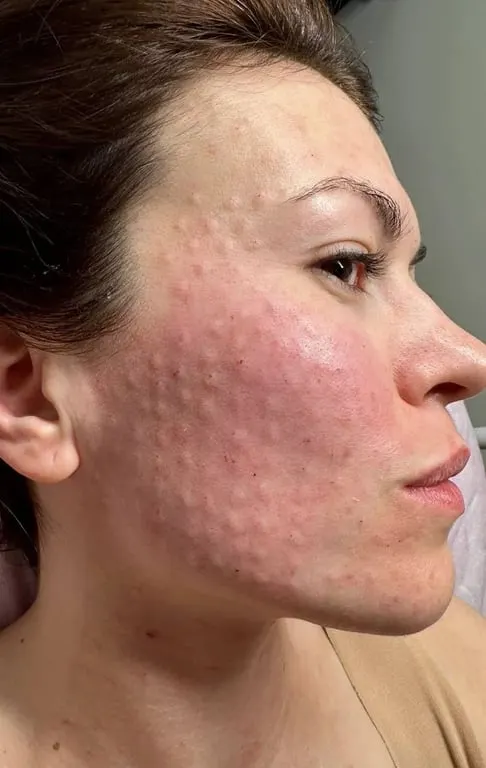Acne and Acne Scar Treatment treatment at House of Aesthetics, DHA Phase 6 Lahore
