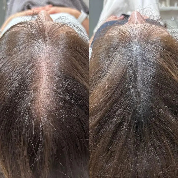 Hair Restoration before and after result — House of Aesthetics DHA Phase 6 Lahore